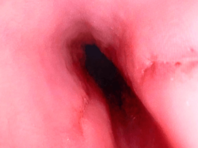 herida penetrante esofago (1)